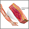 Hematoma muscular