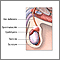 Espermatocele