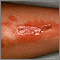 Necrobiosis lipoídica diabética - pierna