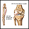 Rodilla desalineada debido a la artritis