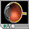 Degeneración macular Degeneración macular