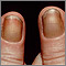 Síndrome de las uñas amarillas