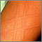 Dermatografismo del brazo