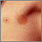 Urticaria pigmentosa en la axila
