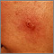 Leishmaniasis mexicana - lesión en la mejilla