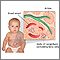 Hiperglucemia