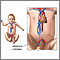 Catéter umbilical