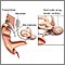 Implante coclear