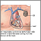 Desfibrilador-cardioversor implantable