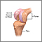 Reemplazo parcial de rodilla - serie