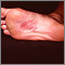 Dermatitis en la planta del pie por níquel