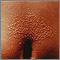 Liquen nítido en el abdomen