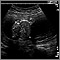 Ultrasonido de un feto normal - medidas del abdomen