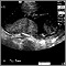 Ultrasonido, placenta normal - Braxton Hicks