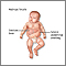Hidropesía fetal