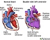 Doble entrada ventricular izquierda