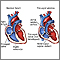Atresia tricuspídea