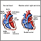 Doble salida ventricular derecha