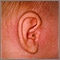 Mastoiditis - vista lateral de la cabeza