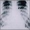 Pulmonía aguda por varicela - Rayos X de tórax