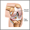 Serie sobre artroplastia de rodilla
