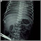Retorno venoso pulmonar total anómalo - rayos X