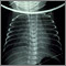 Retorno venoso pulmonar total anómalo - rayos X