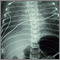Retorno venoso pulmonar total anómalo - rayos X