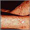 Queratosis actínica en el antebrazo