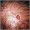 Queratosis actínica en el cuero cabelludo