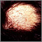 Alopecia areata con pústulas