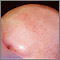 Alopecia total - vista frontal de la cabeza