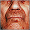 Amiloidosis de la cara