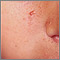 Esclerosis tuberosa, angiofibromas de la cara