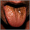 Lengua negra peluda