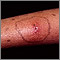Celulitis