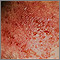 Dermatitis de contacto alérgica - vista de cerca