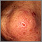 Dermatitis - herpetiforme en la rodilla