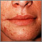 Dermatitis perioral