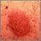Dermatitis por contacto - pustular