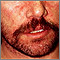 Dermatitis - seborreica en la cara