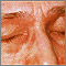 Dermatomiositis - párpados heliotropes
