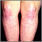 Dermatomiositis en las piernas
