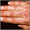 Pápula de Gottron en dermatomiositis