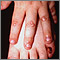 Epidermólisis bullosa, distrófica dominante