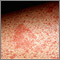 Primer plano - eczema, atópico