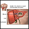 Absceso hepático amebiano