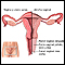 Atrofia vaginal