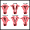 Anomalías uterinas congénitas