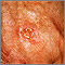 Cáncer de piel - escamocelular primer plano